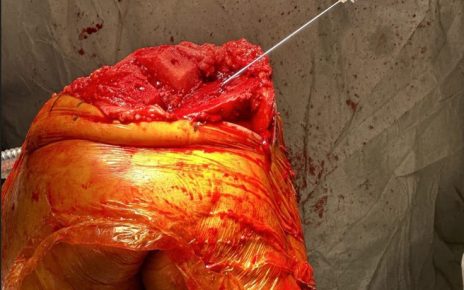 syringe injecting fluid into a surgical site