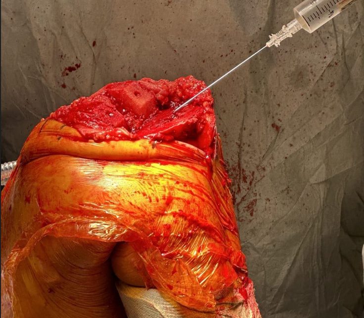 syringe injecting fluid into a surgical site
